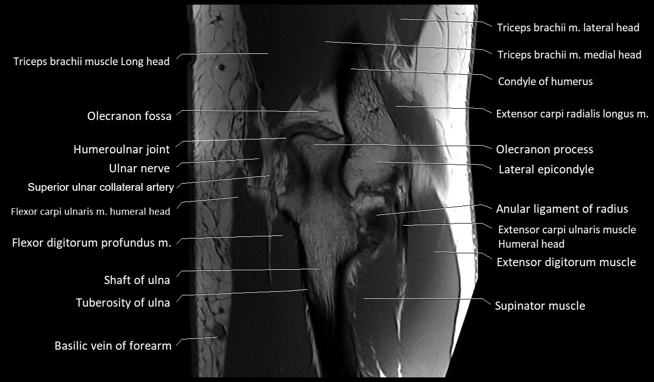 Elbow coronal anatomy image  cross sectional 3T MRI image 24.webp